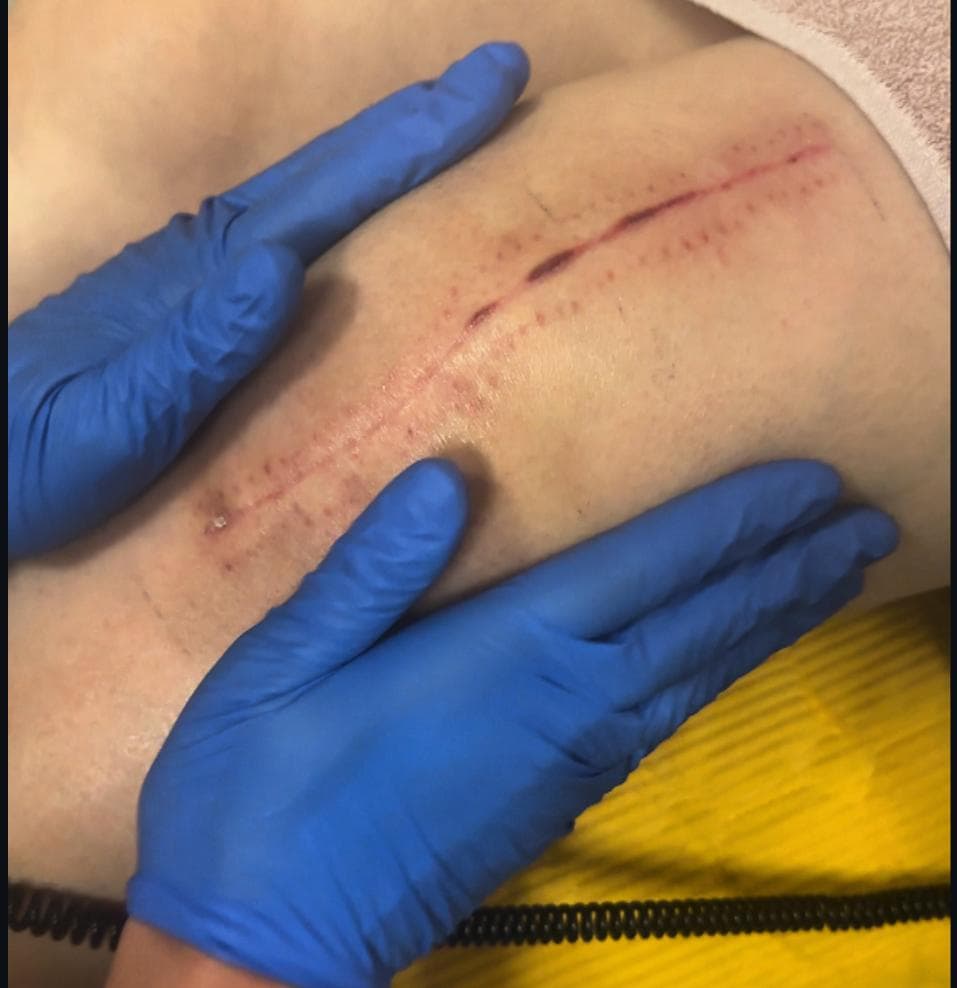 Post Surgery MLD & DOT (Swelling & Pain Relief Therapy)